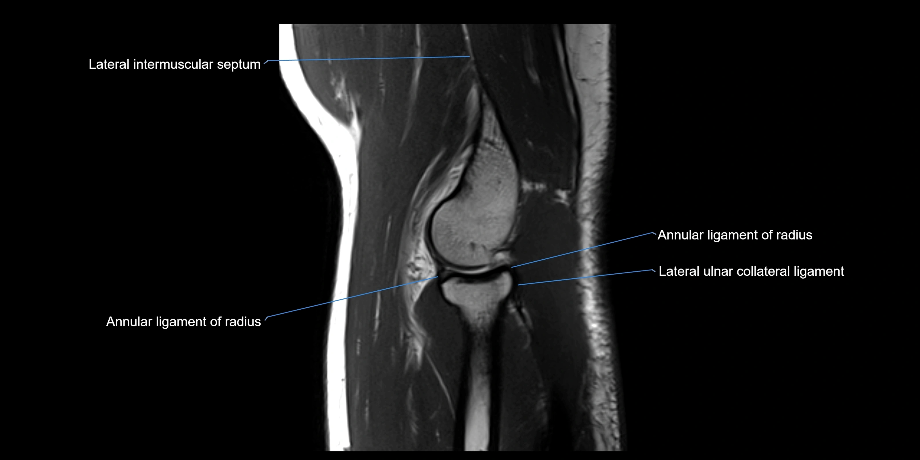 MRI elbow sagittal cross sectional anatomy 3T radiology  image-img-00001-00018.webp